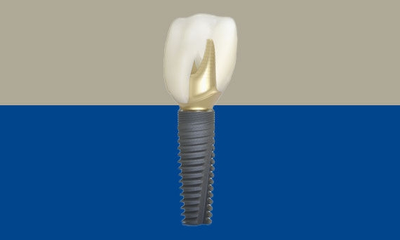 Dentsply Sirona Implants - Astra Tech Implant System EV