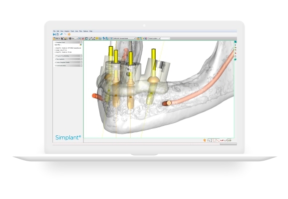 mySimplant planning service