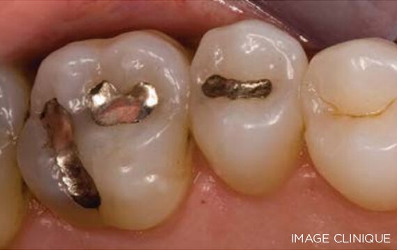 Surefil one restorative is ideal for compromised situations