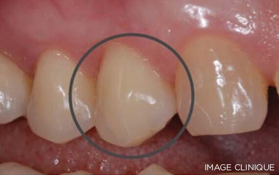 Alternatives to dental amalgam