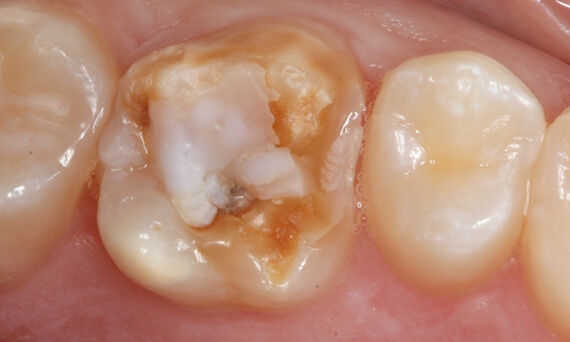 Decay and failing composite restoration before CEREC treatment