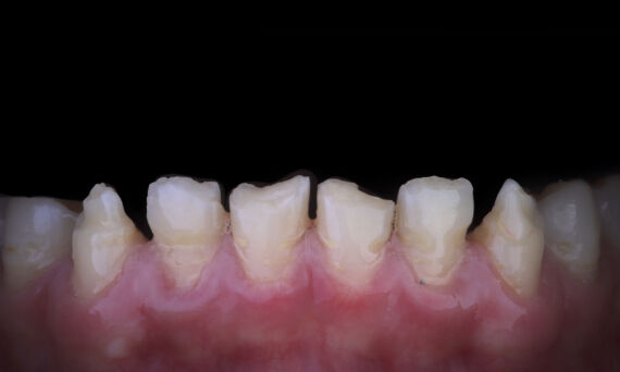 CEREC Tessera with Celtra Ceram Case Study Image - Before