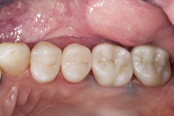 CEREC Tessera inlay, tooth 26