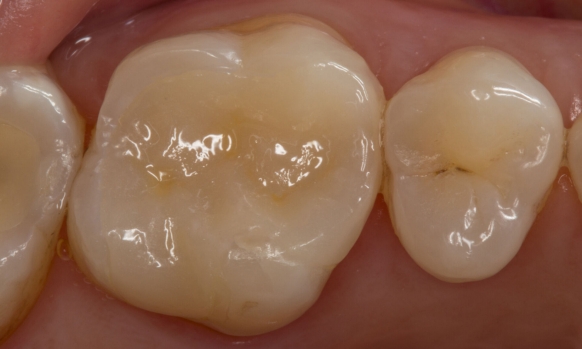 Clinical case, inlay, CEREC Tessera, Sven Rinke