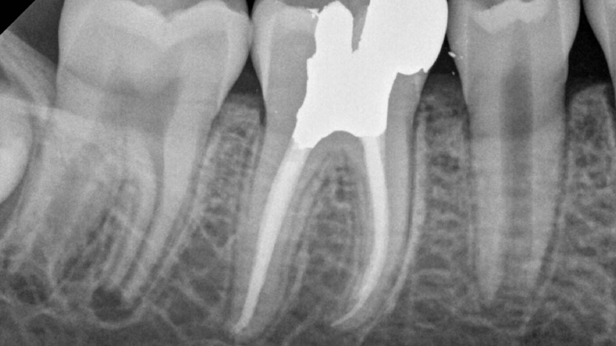 Advanced gutta-percha for radiographic consistency