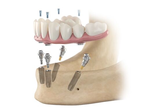 Dentsply Sirona Implants - SmartFix Concept