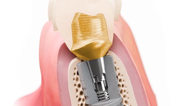 Ankylos Soft Tissue Chamber