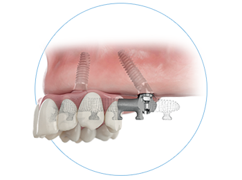 Jaw with Smartfix concept