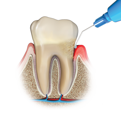 Oraqix Topical Periodontal Gel