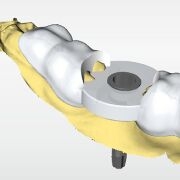 CEREC Guide 3, CEREC SW 5.2