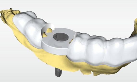 CEREC Guide 3, CEREC SW 5.2