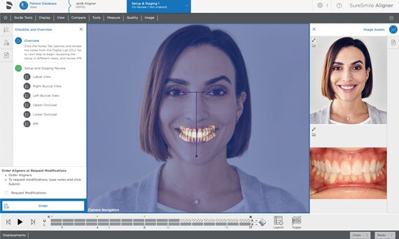 2d 3D Registration SureSmile Aligner Software
