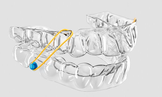 SureSmile Aligner Class Correction
