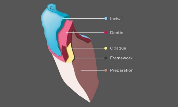 Basic build-up technique in the anterior with Kiss ceramic veneering