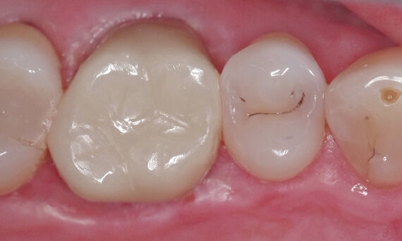 Clinical case, CEREC Zirconia, Todd Ehrlich