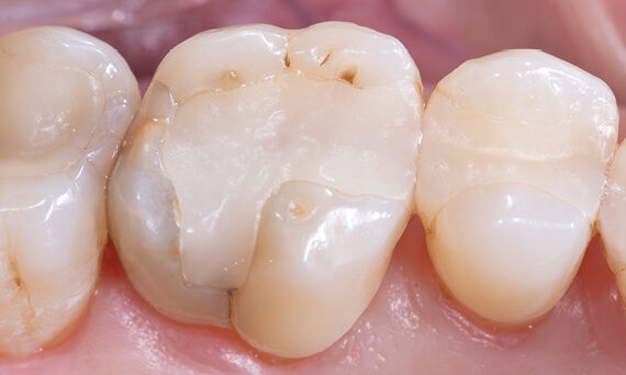 Composietvulling, element 16, voor behandeling met CEREC