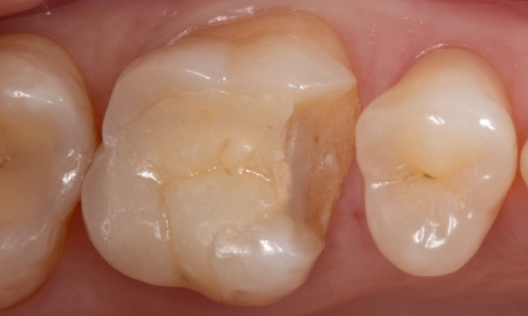 Fractured ceramic restoration before CEREC treatment