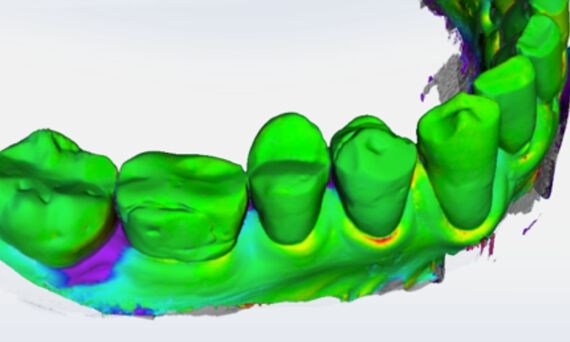 Gingival Recession Measurement, difference