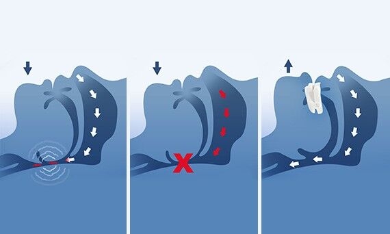 Functionality of Mandibular Advancement Device (MAD) 