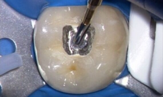 Clinical Image of a cavity access