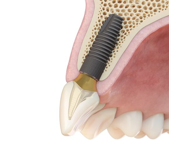 dental implant treatment planning