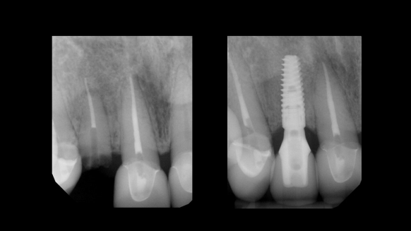 dental implant treatment planning