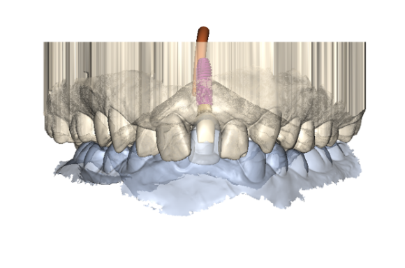 dental implant treatment planning