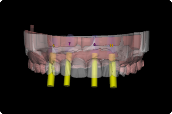 dental implant