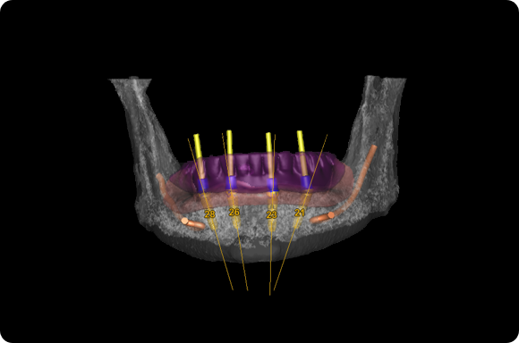 dental implant