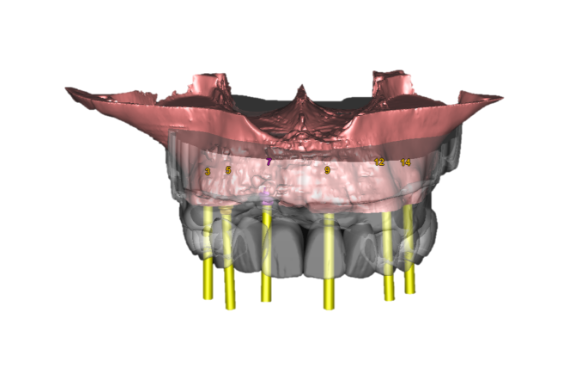 dental implant