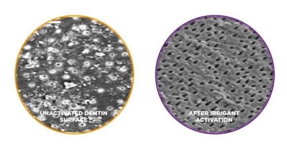 More opened dentinal tubules after activating the irrigants with EndoActivator