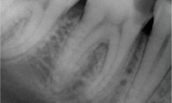 Image of Preoperative X-Ray