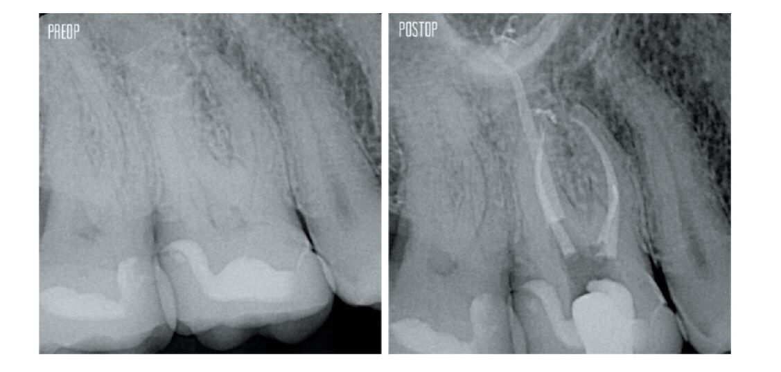 X-Ray images of PreOP and PostOP