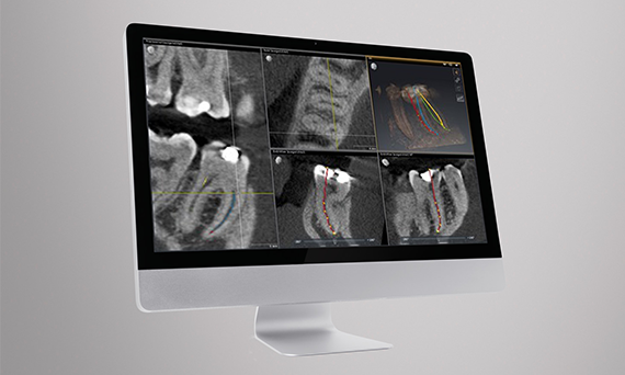 Monitor met de dentale software SICAT Endo