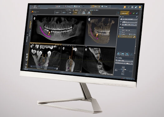 Monitor met de dentale software SICAT Implant