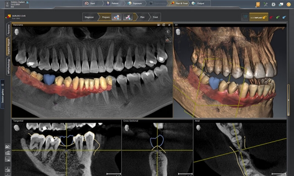 Tandheelkundige implantaat planningssoftware SICAT Implant