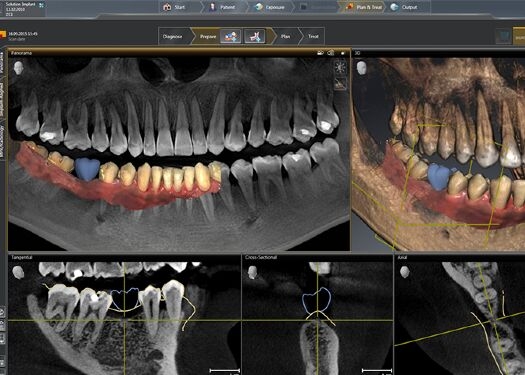 SICAT Implant Software