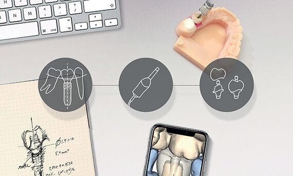 Digital Implant Workflow