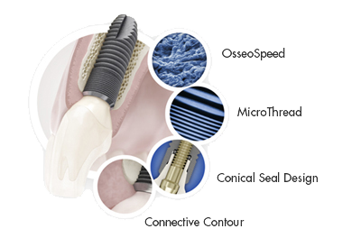 Astra Tech Implant System BioManagement Complex