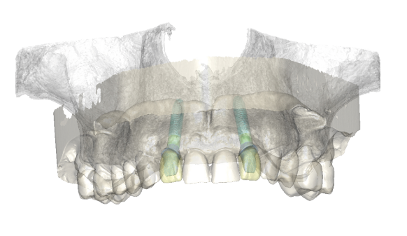 Simplant dental planning