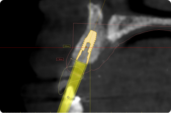 Dental Implant placement