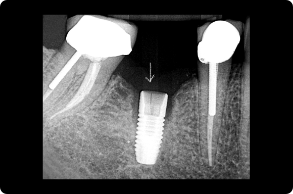 Surgical complication diagnosis