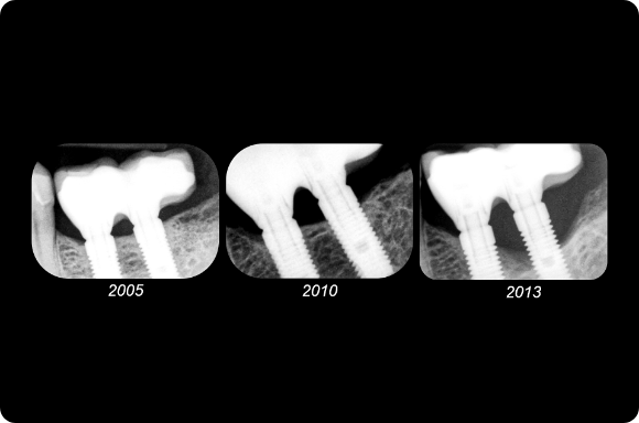 Peri-implantitis treatment