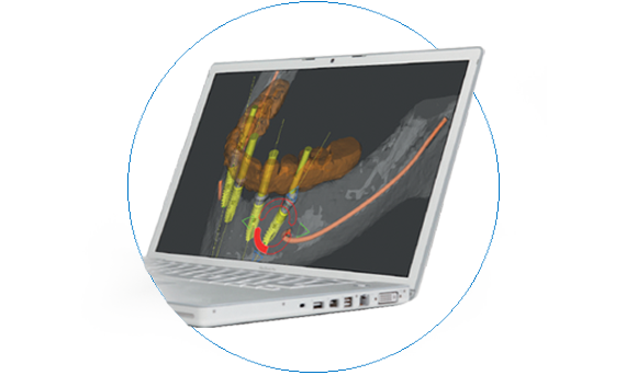 Simplant computer guided implant treatment