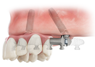 Immediate, full-arch restorations on four implants