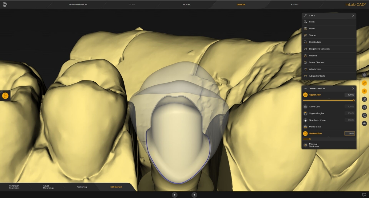 inLab CAD Software, Virtual insertion of a restoration