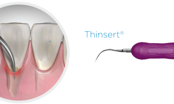 Thinsert Ultrasonic opzetstuk