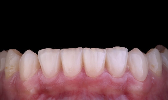 CEREC Tessera with Celtra Ceram Case Study Image - After