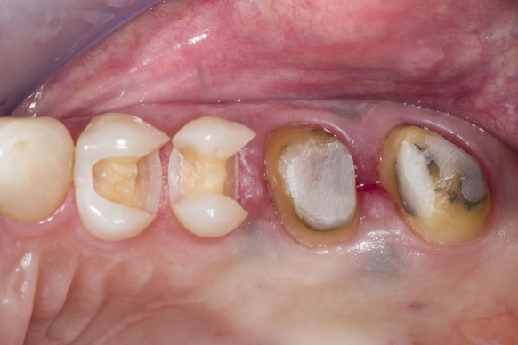 Fractured ceramic restoration before CEREC treatment