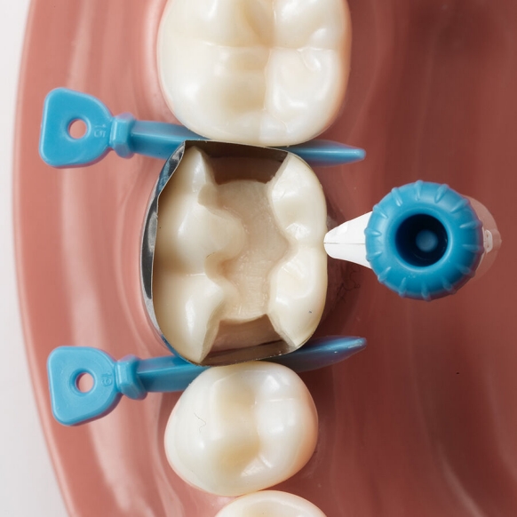 Veelzijdige plaatsingsmogelijkheden van Palodent 360: optie 5